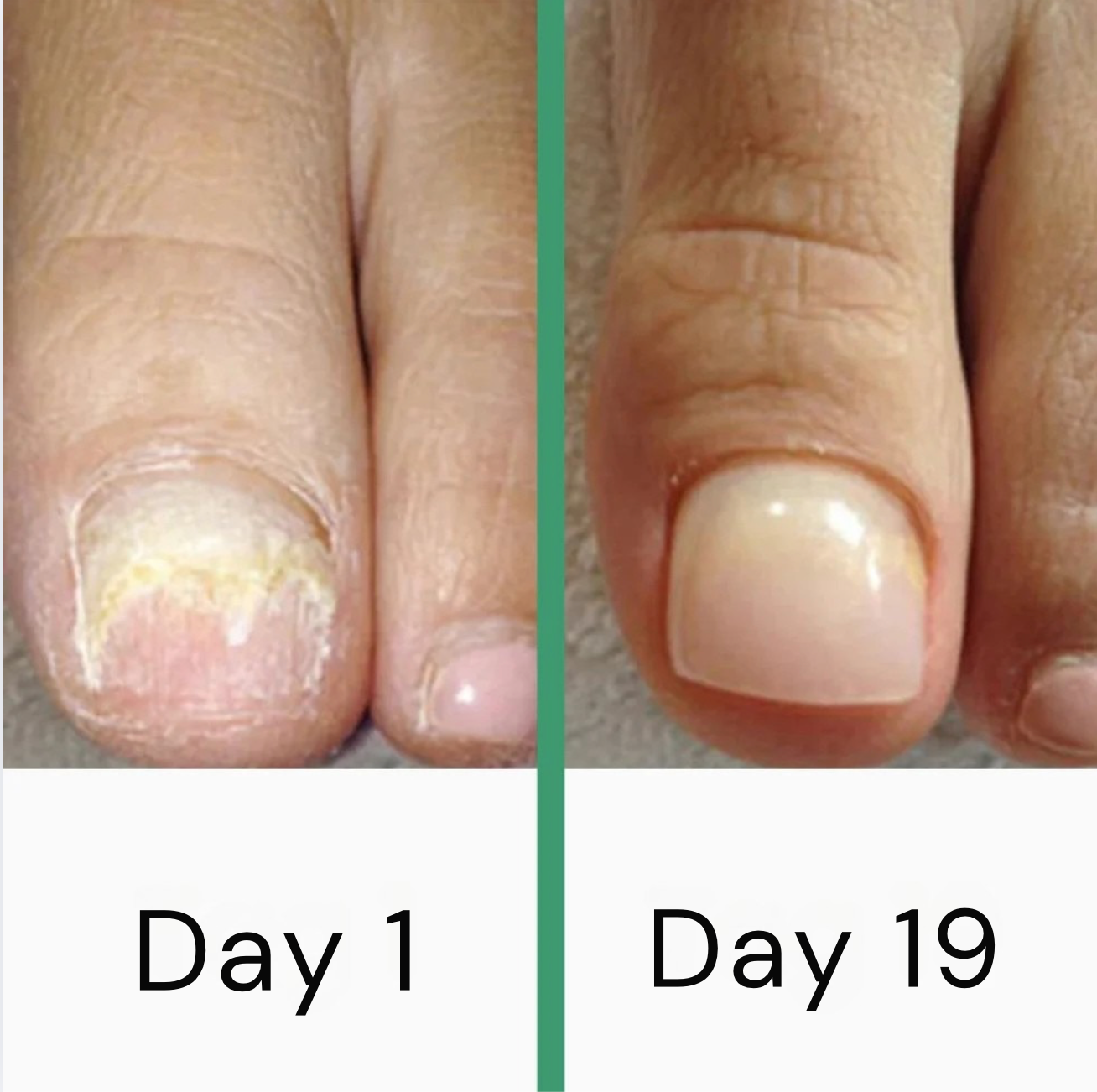 PODOclear® LLLT Fungal Nail Therapy