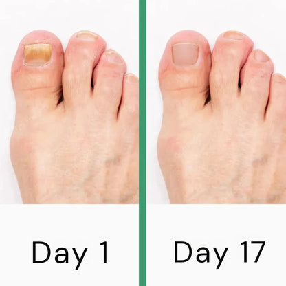 PODOclear® LLLT Fungal Nail Therapy